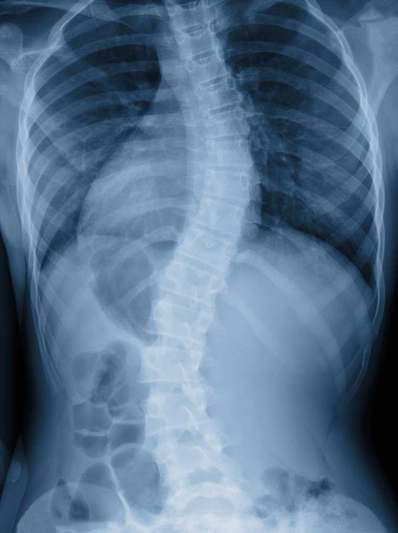 Scoliosis Sebastopol, CA